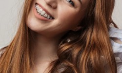 Advantages Of Selecting Invisalign