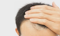 Unveiling the Permanence of Hair Transplant Results