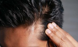 What is the difference between micrografts and minigrafts in hair transplants?