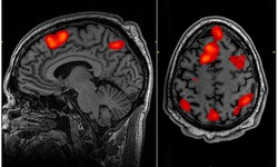 Unraveling the Debate Between MRI and CT Scans for Brain Injury