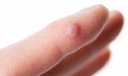 The Benefits of Cryotherapy for Wart Removal