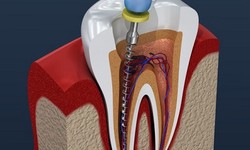Root Canal Treatment: Understanding the Procedure and Its Benefits