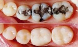 Exploring the Different Types of Tooth-Colored Dental Fillings
