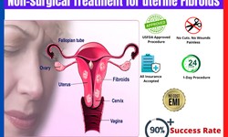 Best treatment for uterine fibroids in Hyderabad