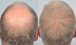 What is the significance of graft survival in a hair transplant?