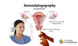 The Role of Sonosalpingography (SSG) in Diagnosing Tubal Infertility: What You Need to Know