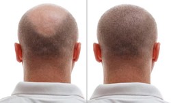 Transformative Tales: Before and After Stories of Hair Transplants in Turkey
