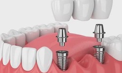 Post-Operative Care for Dental Implants: Ensuring Long-Term Success