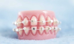 Straighten Up and Smile! Understanding Orthodontics for All Ages