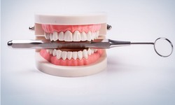 Beyond Missing Gaps: Scottsdale's Journey to Perfecting Smiles with Tooth Implants