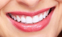 Beyond Aesthetics: The Psychological Impact of a Hollywood Smile