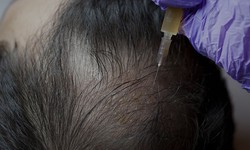 Can women also benefit from hair transplant procedures?