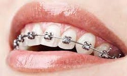 Orthodontic Excellence: Dubai's Leading Dental Braces Specialists