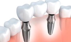Innovative Dental Solutions: Exploring Implant Techniques in Dubai