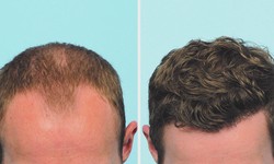 Restrictions on Physical Activities Following a Hair Transplant