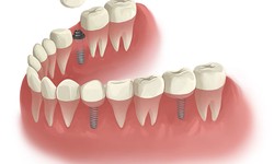 Factors Influencing Tooth Extraction: Navigating the Challenges