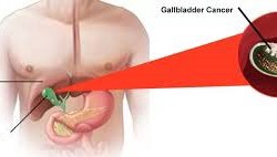 Laparoscopic Cancer Surgery for Effective Treatment
