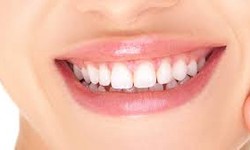 Achieve the Red Carpet Smile: A 17-Step Hollywood Smile Transformation