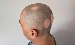 What are the commonplace signs of Alopecia Areata? & Treatment