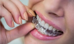 Straight From the Heart: Embracing Invisalign in Westport for a Perfect Smile