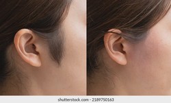 Precision in Sideburn Hair Transplant Surgery