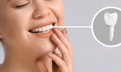 Revitalize Your Smile: A Comprehensive Guide to Dental Implant Treatment