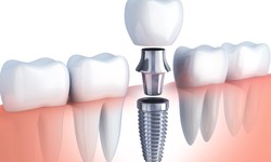Dental Implants Aftercare Tips