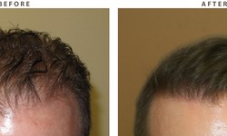 Comparing FUE vs. FUT Hair Transplant Techniques