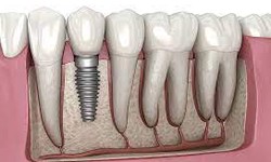 Common Misconceptions about Dental Implants: Debunked!