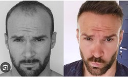 Hair Transplants: Restoring Confidence and Natural Appearance