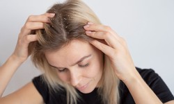 How To Get Rid Of Dandruff Effectively
