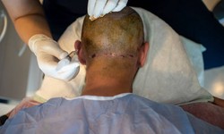 Embracing Change: The Journey of Hair Transplantation