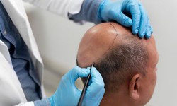 Crowning Glory: The Artistry and Expertise of Turkish Hair Transplant Procedures