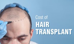 Factors Deciding the Cost of Hair Transplant in Mumbai- Surgeon Guide