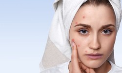 Exploring Homeopathic Treatment for Acne