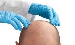 Expected Results and Timeline for Hair Transplant in Abu Dhbai