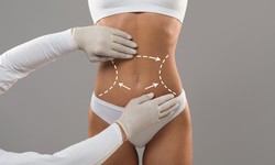 Unveiling the World of Liposuction in Islamabad: An In-Depth Exploration