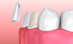What Problems Can Dental Veneers Fix