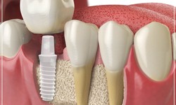 How Dental Implants Can Help Treat Facial Trauma