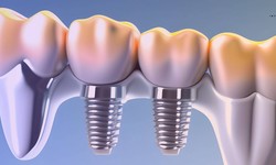 What Are the Main Reasons for Considering Dental Implants?