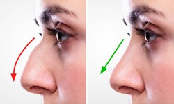 Exploring Nose Rhinoplasty Costs in Mumbai: A Comprehensive Guide