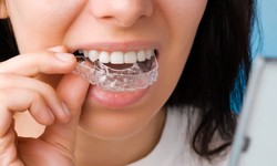 Choosing the Right Invisalign Provider: Your Guide to a Confident Smile
