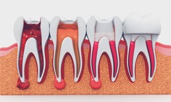 Comprehensive Guide to Root Canal Treatment in the UK: Procedure, Cost, and Recovery
