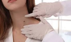 Smooth Skin Ahead: Skin Tag Removal in Thane Unveiled