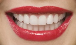 Achieving a Radiant Smile: The Benefits of Professional Teeth Whitening Services