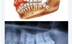 Know How The Wisdom Teeth Extractions Process is Done
