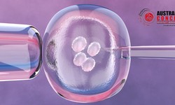 What to Know About in Vitro Fertilization (IVF)