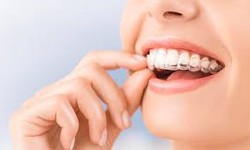 The Benefits of Invisalign that transforms your child’s smile