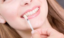 How to Find the Best Dental Veneers in Dubai