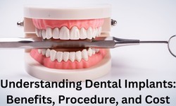 Understanding Dental Implants: Benefits, Procedure, and Cost